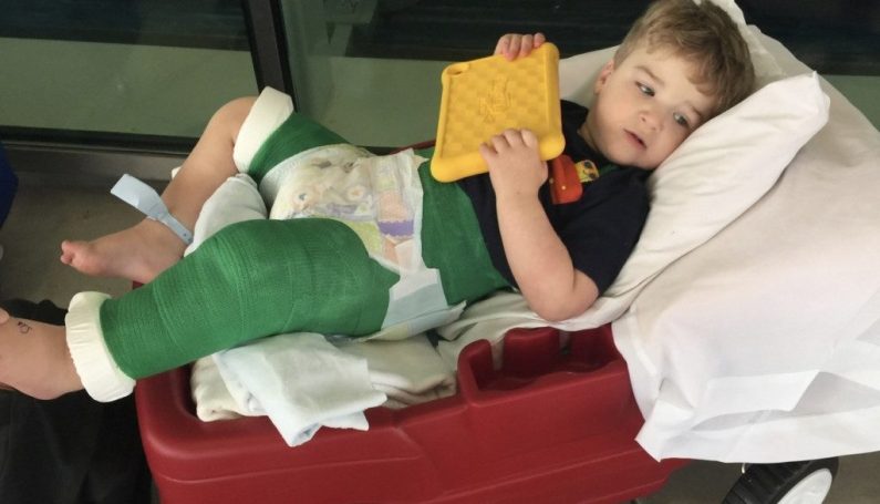 toddler fractured femur, hip spica cast