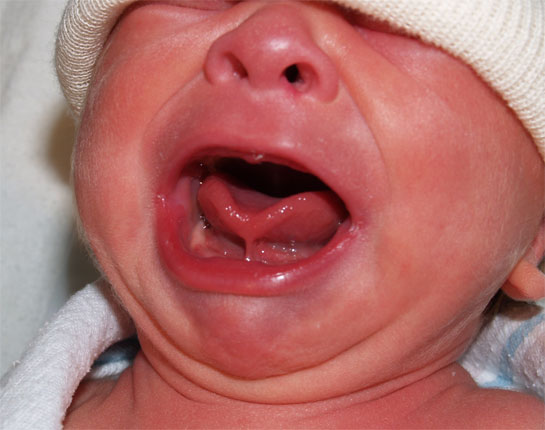 tongue tie — Boston Moms Blog